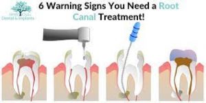Signs That You Need Root Canal Treatment
